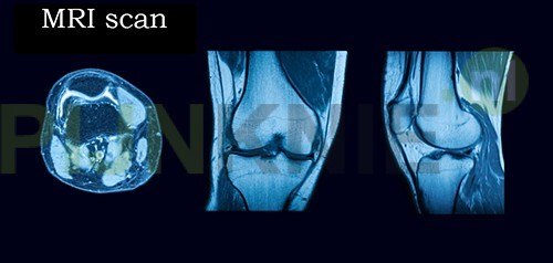 Doe een poging Vlek Wafel MRI scan van de knie - Pijn Knie